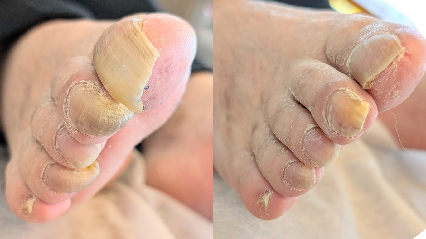 高齢者の爪切り